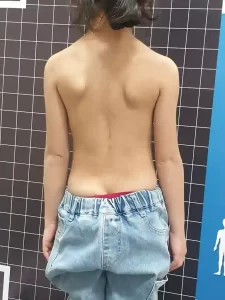 ۷ حرکت اصلاحی عالی برای اسکولیوز