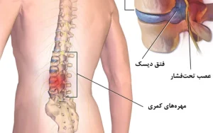 درمان دیسک کمر در مشهد