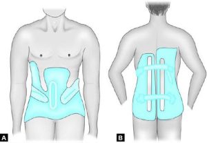 بریس اسکولیوز