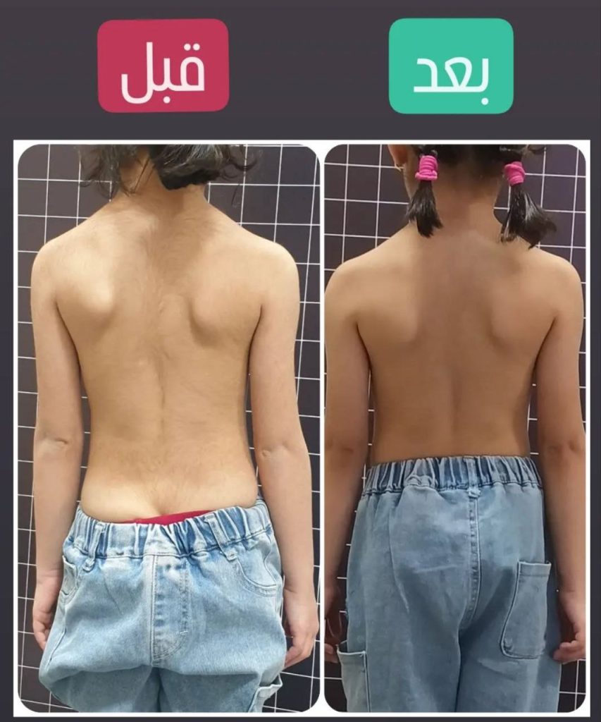 نمونه درمان اسکولیوز در مشهد راستا