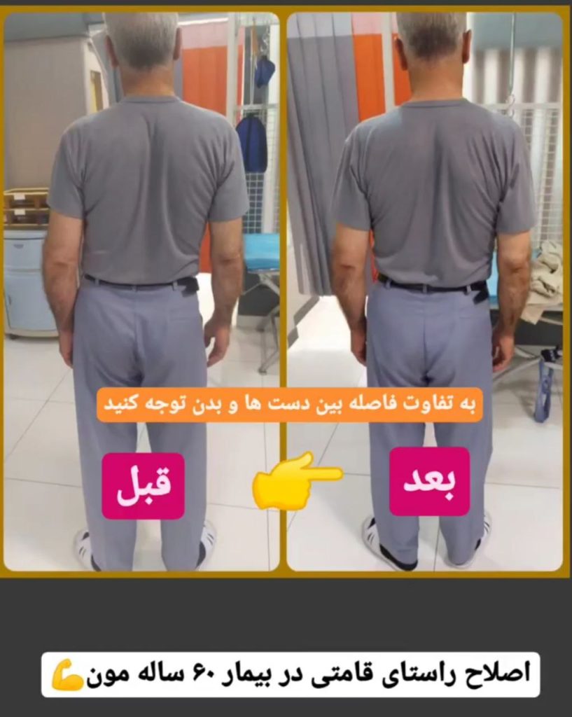 نمونه درمان اسکولیوز در مشهد