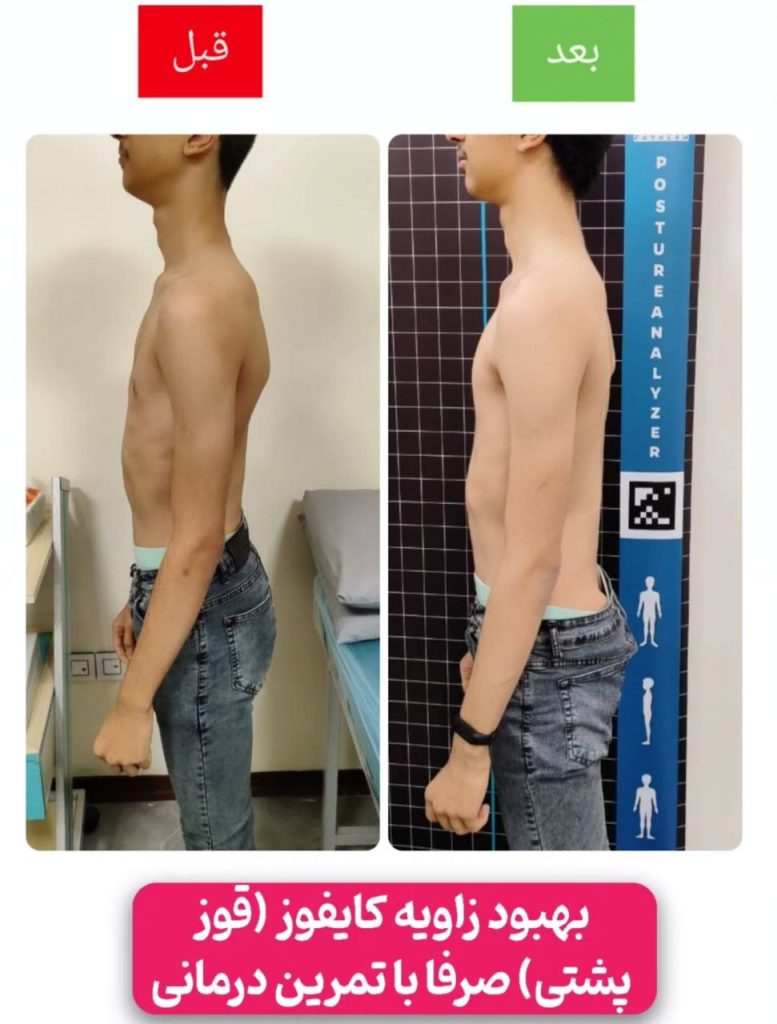 نمونه درمان کایفوز در مشهد