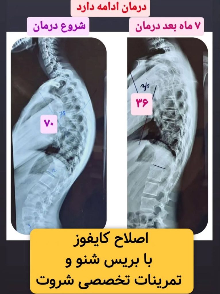 درمان کایفوز در مشهد