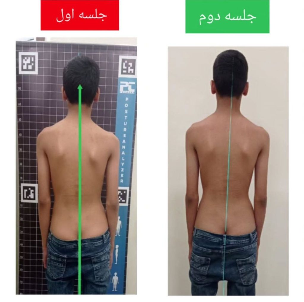 نمونه درمان اسکولیوز در مشهد