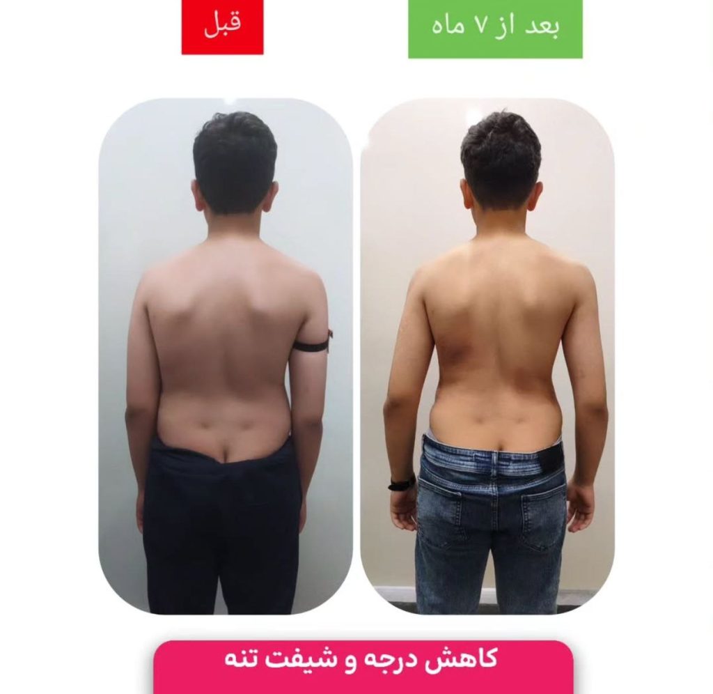 نمونه درمان اسکولیوز در مشهد