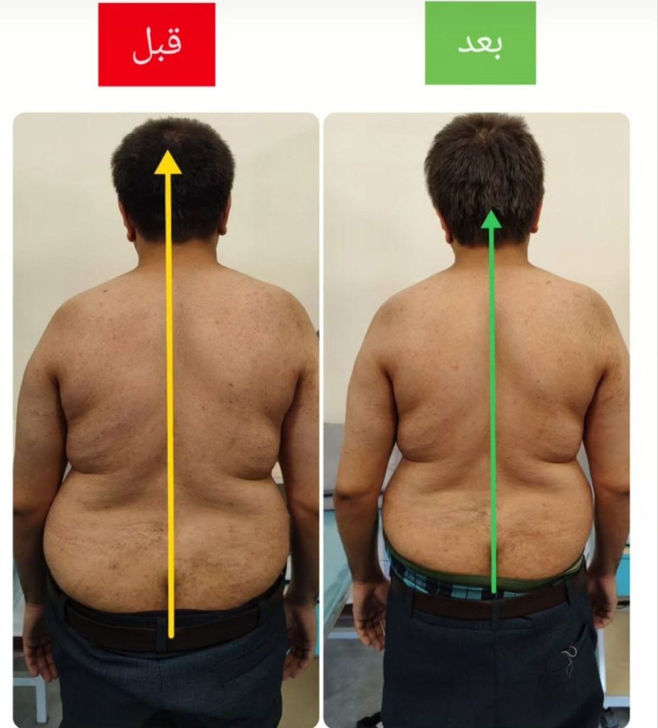 نمونه درمان اسکولیوز در مشهد