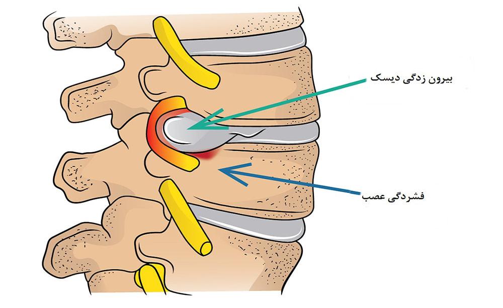 درمان دیسک کمر در مشهد