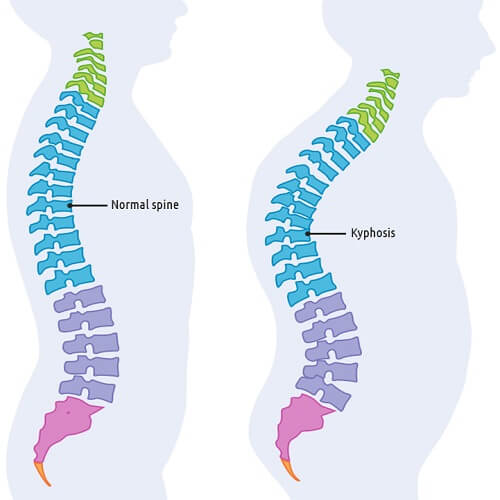 درمان قوز در مشهد