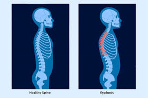 بیماری‌هایی که باعث قوز کمر می‌شوند