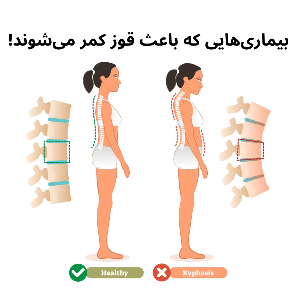 بیماری‌هایی که باعث قوز کمر می‌شوند