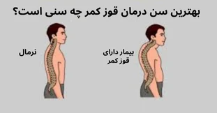 بهترین سن درمان قوز کمر چه سنی است؟