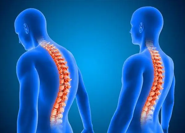 عوارض قوز کمر یا همان کیفوز چیست