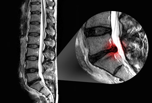 تمرینات مک کنزی