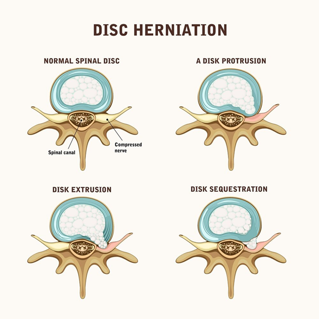دیسک کمر(Lumbar disc) 