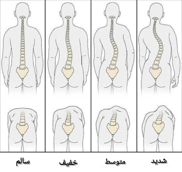 انواع اسکولیوز