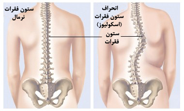 اسکولیوز در بزرگسالان چیست و چرا اهمیت دارد
