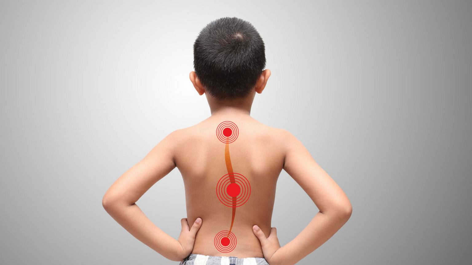 اسکولیوز در کودکان چیست و چرا باید به آن توجه کنیم؟