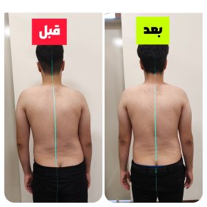 درمان اسکولیوز در نوجوانان