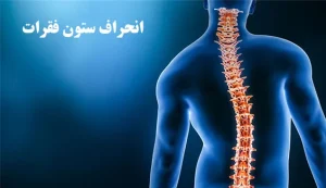 درمان اسکولیوز (انحراف کمر)