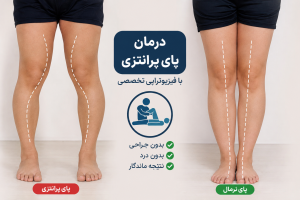 درمان پای پرانتزی در خرم‌آباد