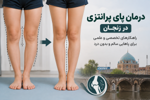 درمان پای پرانتزی در زنجان