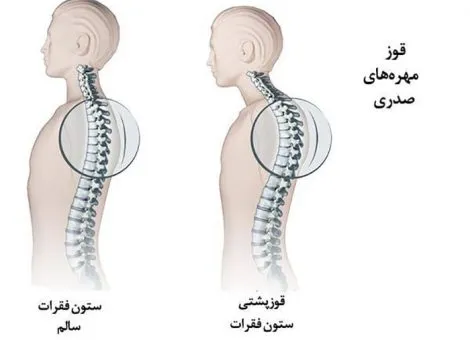 درمان قوز کمر در مشهد