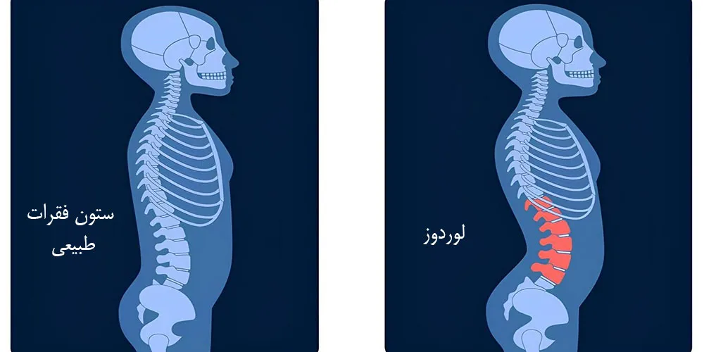 درمان گودی کمر در تهران