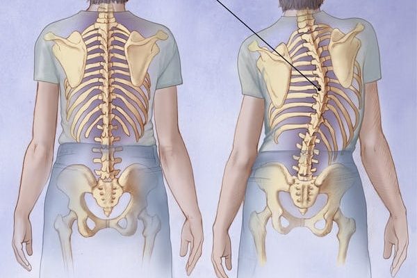 اسکولیوز چند درجه نیاز به جراحی دارد؟