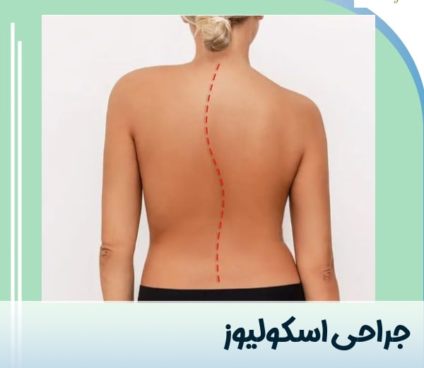 آیا اسکولیوز را جراحی کنیم یا نه؟