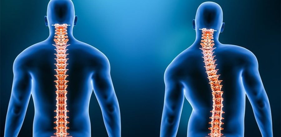 مزایا و ریسک های جراحی اسکولیوز
